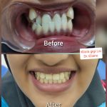 DENTIST KLINIK GIGI LAI(TEMERLOH) BRACES & VENEER