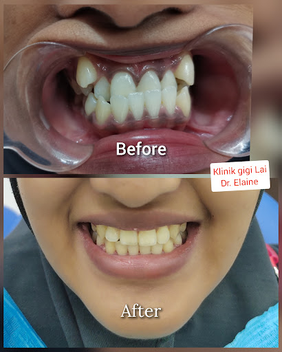 DENTIST KLINIK GIGI LAI(TEMERLOH) BRACES & VENEER