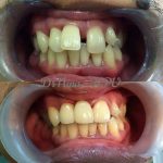 Klinik Pergigian Uda , Braces , Denture , Bridge , Crown