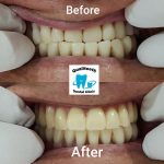 Qualiteeth Dental Clinic 优质牙科@ Rawang (Opens Everyday)- Braces Centre since 2017