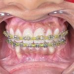 T Care Dental Clinic Puchong (Bandar Puteri) Braces & Implant Specialist