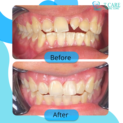 T Care Dental Puchong Jaya (Braces Specialist & Certified Invisalign Provider)